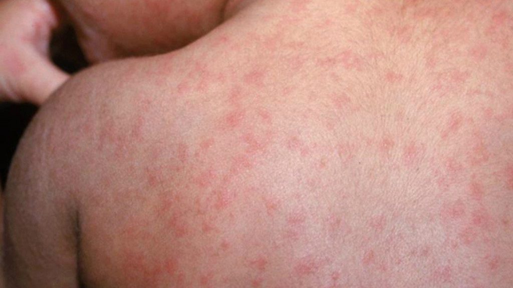 México registra primera muerte por el actual brote de sarampión